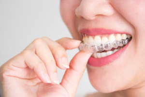 Segredo da manutenção fácil do Invisalign em BH