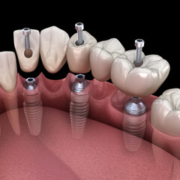 Implantes dentários em BH