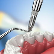 implante dentário bh