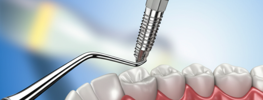 implante dentário bh